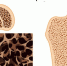 osteoporoz_foyku2wi.jpg - Городская больница №1